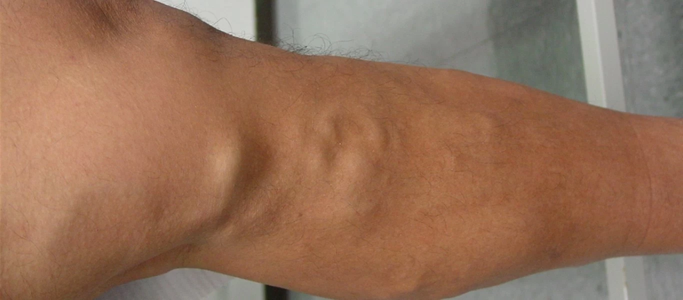 Κιρσοί: Αυτές είναι οι σοβαρές ασθένειες που μπορεί να κρύβουν